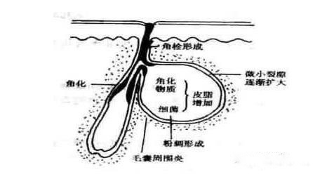 背部祛痘皂什么牌子好？6款祛痘皂实力pk，祛痘NO.1国产品牌躺赢 